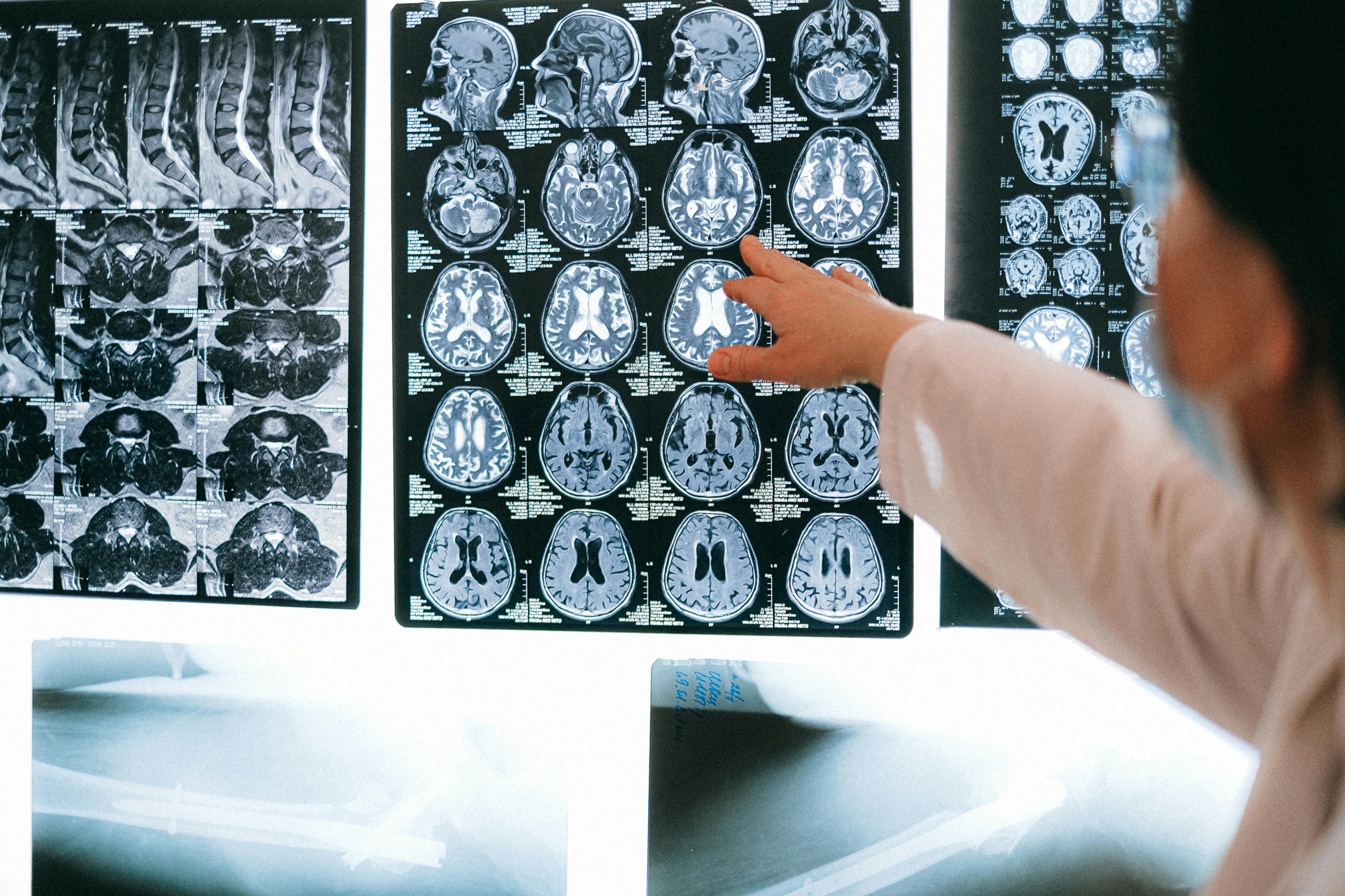 Radiologist pointing at brain MRI scans on a lightboard in a clinical setting